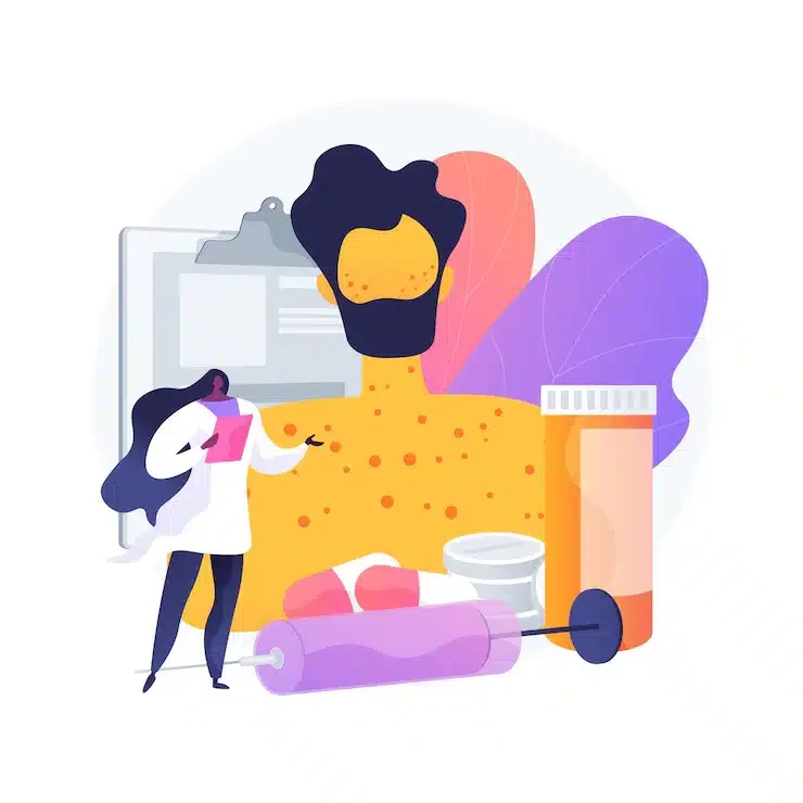 psoriasis treatment